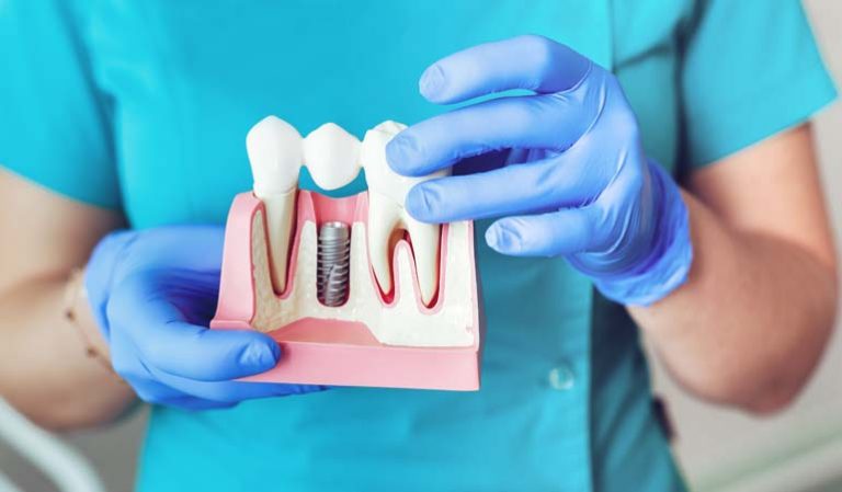 Dental Implant